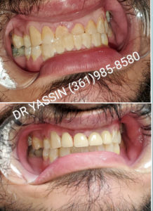 Dr. Yassin transforming patient's smile. Dental services include dentures, dental extractions, mini dental implants, veneers, fillings, crowns, dental cleanings, bridges, root canals, and complete mouth restoration.