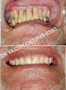 Dr. Yassin transforming patient's smile. Dental services include dentures, dental extractions, mini dental implants, veneers, fillings, crowns, dental cleanings, bridges, root canals, and complete mouth restoration.