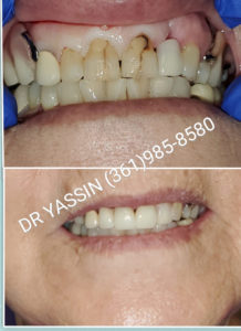 Dr. Yassin transforming patient's smile. Dental services include dentures, dental extractions, mini dental implants, veneers, fillings, crowns, dental cleanings, bridges, root canals, and complete mouth restoration.