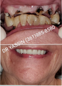 Dr. Yassin transforming patient's smile. Dental services include dentures, dental extractions, mini dental implants, veneers, fillings, crowns, dental cleanings, bridges, root canals, and complete mouth restoration.