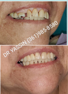 Dr. Yassin transforming patient's smile. Dental services include dentures, dental extractions, mini dental implants, veneers, fillings, crowns, dental cleanings, bridges, root canals, and complete mouth restoration.