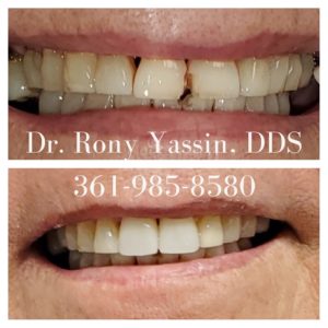 Dr. Rony Yassin transforming patient's smile. Dental services include dentures, dental extractions, mini dental implants, veneers, fillings, crowns, dental cleanings, bridges, root canals, and complete mouth restoration.