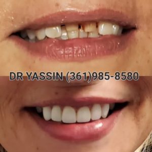 before and after dental transformation at family dentistry by baria Yassin DMD and rony Yassin DDS