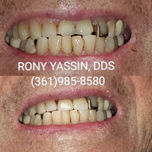 Dr. Yassin transforming patient's smile. Dental services include dentures, dental extractions, mini dental implants, veneers, fillings, crowns, dental cleanings, bridges, root canals, and complete mouth restoration.